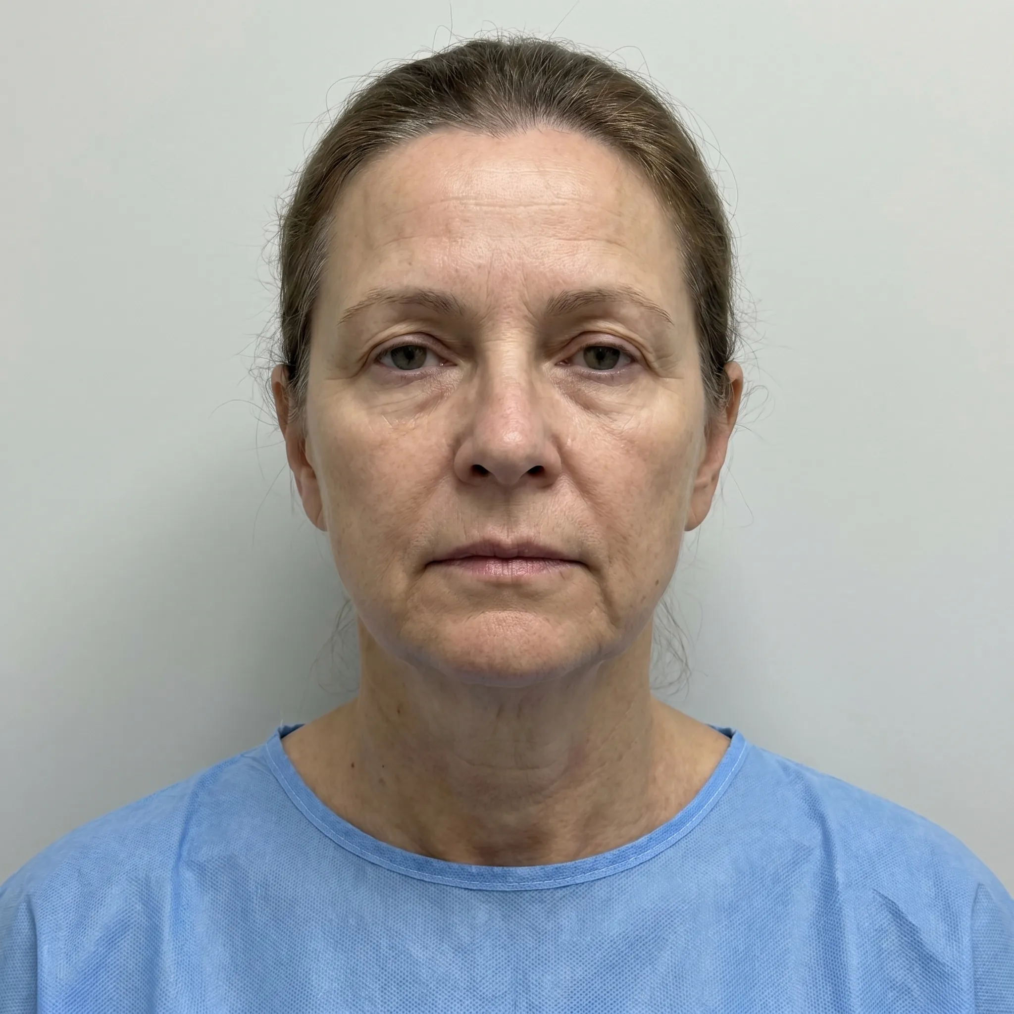 Facial rejuvenation pre-operative status
